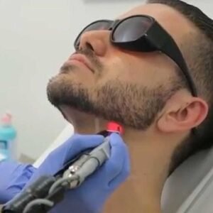 Laser Beard Shaping