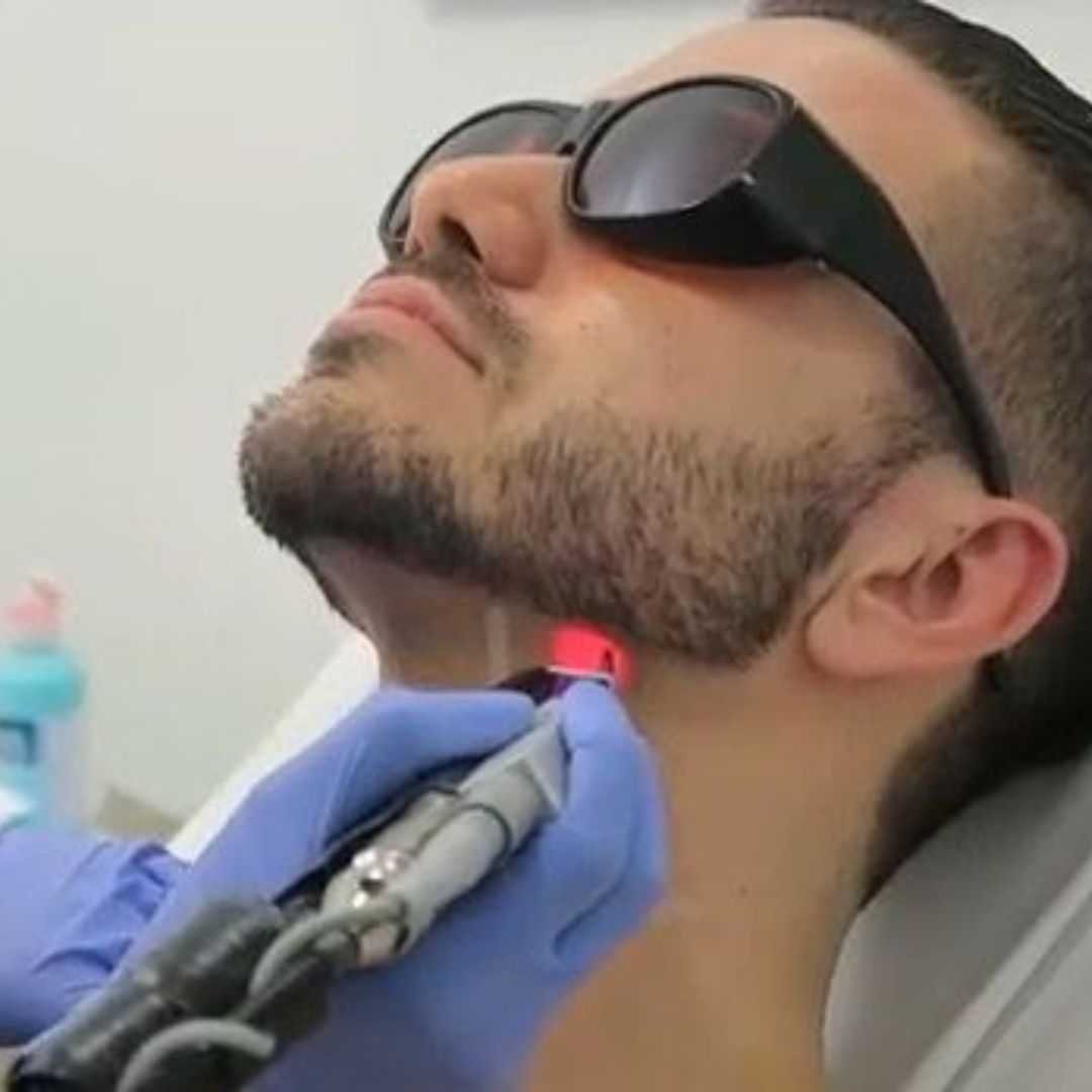 Laser Beard Shaping